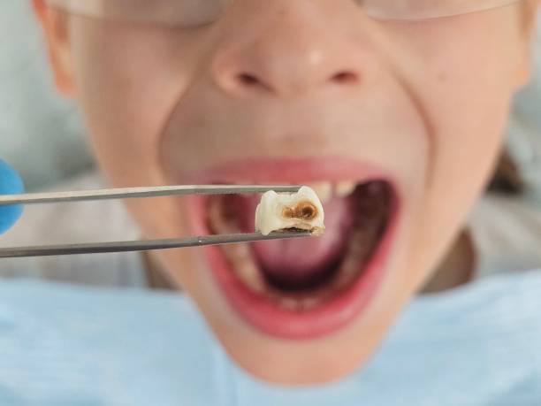 Best Emergency Dental Care for Abscessed Tooth in Lincoln, MO
